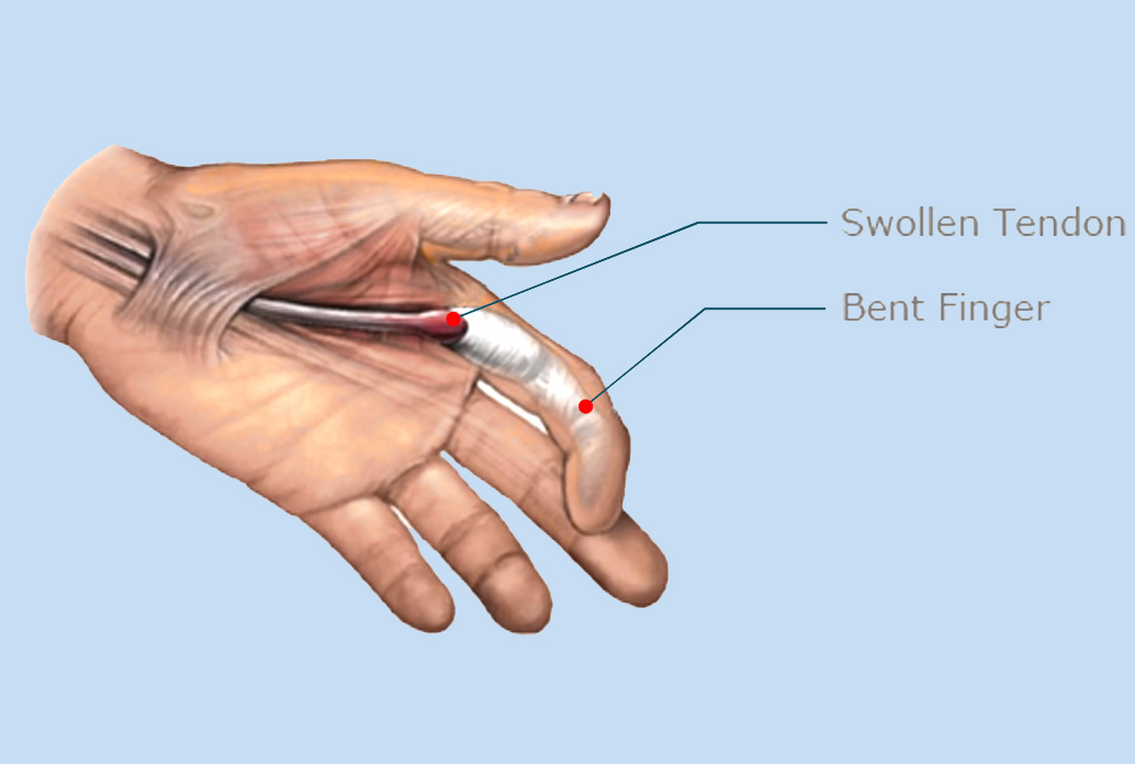Trigger Finger Treatment
