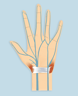 Ulnar Tunnel Syndrome  South Florida Hand Center