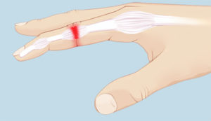 Sprained-Finger