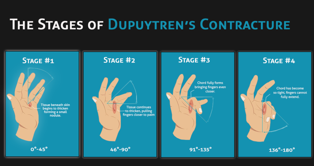 dupuytren s contracture causes)